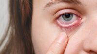 Konjungtivitis Picu Mata Merah, Salah Pengobatan Bisa Ancam Penglihatan