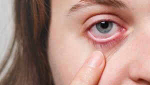 Konjungtivitis Picu Mata Merah, Salah Pengobatan Bisa Ancam Penglihatan
