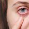Konjungtivitis Picu Mata Merah, Salah Pengobatan Bisa Ancam Penglihatan