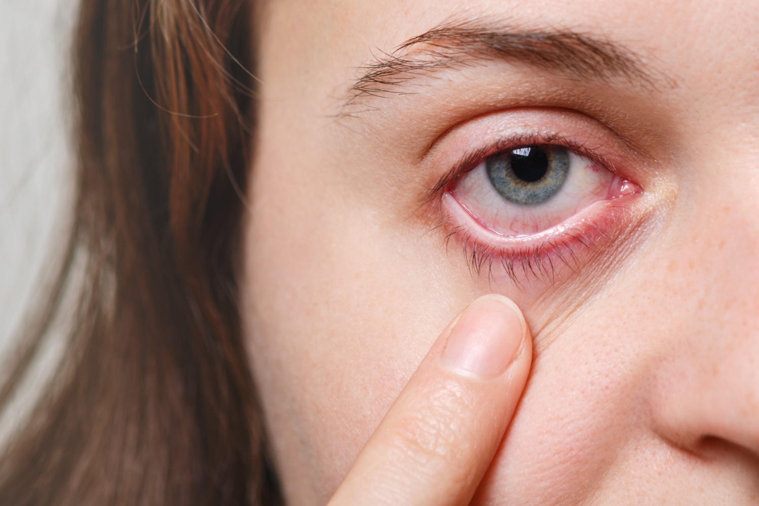 Konjungtivitis Picu Mata Merah, Salah Pengobatan Bisa Ancam Penglihatan
